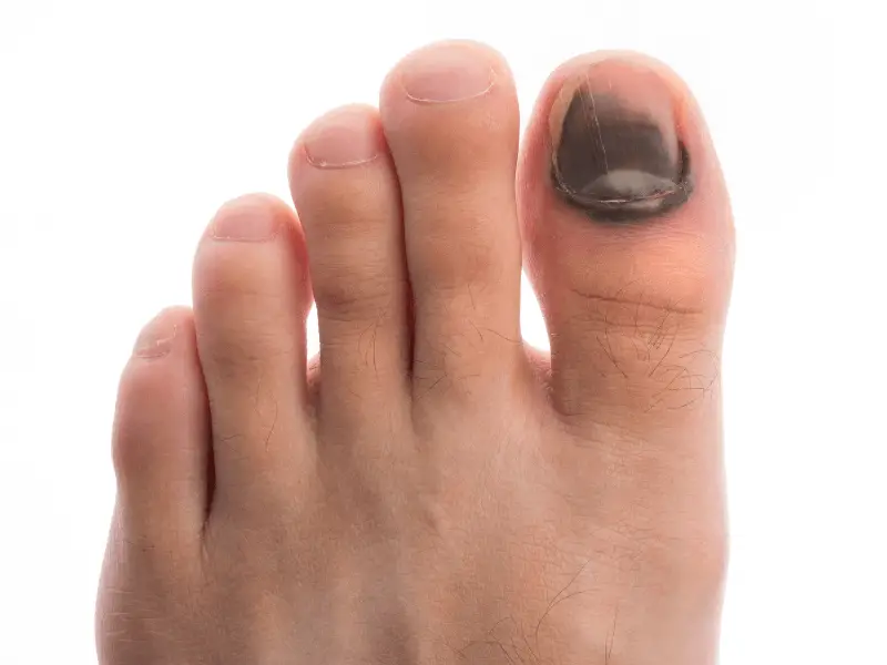 4. 5 Tips for Painting Nails with an Injured Toe - wide 6