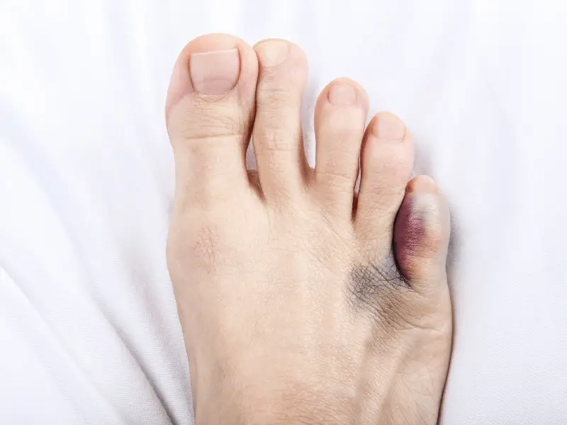 Broken Toe: Causes, Symptoms, and Treatment - wide 5